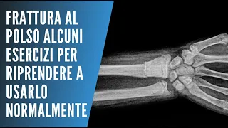 Esercizi di Riabilitazione del Polso Dopo il Gesso: Guida PassoPasso per una Ripresa Sicura