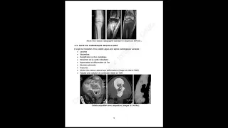 Infections osseuses et articulaires