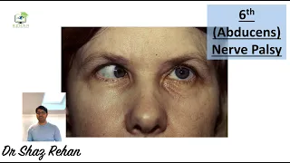 Sixth (Abducens) Nerve Palsy: What is it? Why it Occurs? Will it get Better? Will I need Surgery?