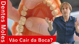 Dentes Moles - Como Saber Se Tenho Dentes Moles, Se Irão Cair da Boca e Como Tratar Sem Implantes?