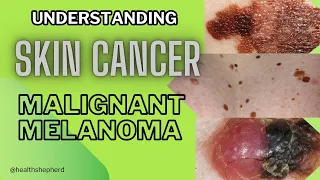 Princess Kate Middleton's cancer diagnosis: Malignant Melanoma Symptoms, Diagnosis, and Treatment