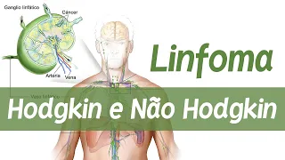 Linfoma de Hodgkin e Não Hodgkin │ Fisiopatologia e Patologia