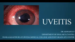 uveitis