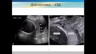 Акушерські кровотечі