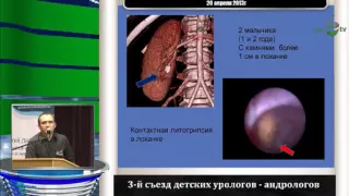 Суров Р В - Первый опыт эндоскопического лечения мочекаменной болезни у детей