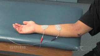 Wrist and Finger Flexion Electrode Placement for Muscle Stimulation