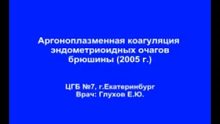 Аргоноплазменная коагуляция эндометриоидных очагов брюшины 2005 г