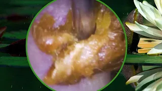 Fully Blocked Ear Wax Removal