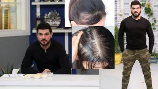 Alopecia Areata Treatment Urdu - Hair loss - Patchy Hair Loss |Dr Khurram Home Remedy | Morning Star