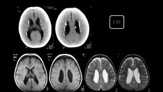 Imaging of Intracranial infections   Prof Dr  Mamdouh Mahfouz In Arabic