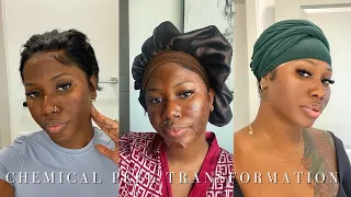 UNBELIEVABLE RESULTS OF MY CHEMICAL PEEL TRANSFORMATION!