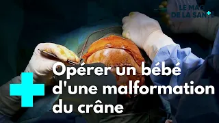 Craniosténose : naitre avec les os du crâne soudés - Le Magazine de la Santé