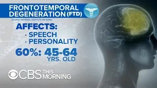 Why a form of dementia that changes people's personalities is “very commonly misdiagnosed”