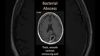 Bacterial versus Fungal Abscess on imaging, how to tell the difference #medical