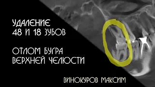 Удаление зубов мудрости и отлом бугра. Максим Винокуров