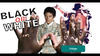 Майкл Джексон мутировал в белый цвет | Витилиго Майкл Джексон | michael jackson black or white