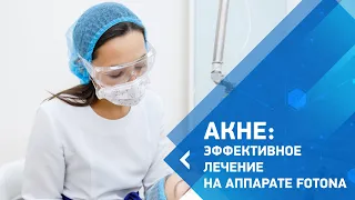 Акне: эффективное лечение на аппарате FOTONA