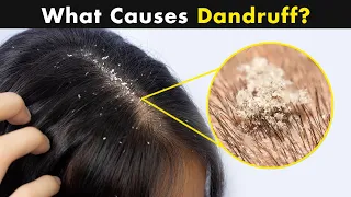 What is Dandruff? | Causes And Treatment (Urdu/Hindi)