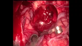 Clipping of a ruptured distal PICA aneurysm