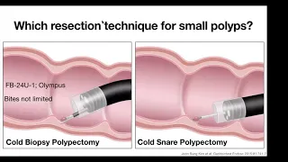 Endoscopy Refresher - Class 17 - Cold Snare Resection