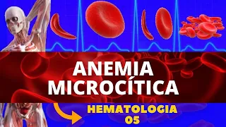 ANEMIAS MICROCÍTICAS - HEMATOLOGIA (ESTUDOS DAS ANEMIAS)