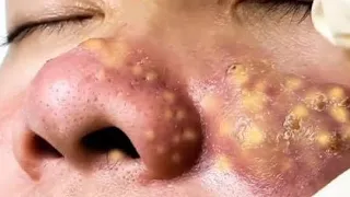 Cystic Acne Extraction This Week, Blackheads Removal #0081