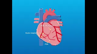 Inferior STEMI