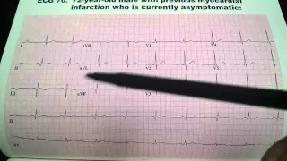 Previous Myocardial Infarction EKG ECG Uri Ben Zur MD
