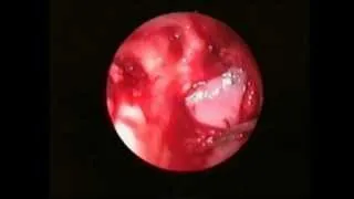 BLOWOUT FRACTURE + cartilage repair ( Endoscopic )