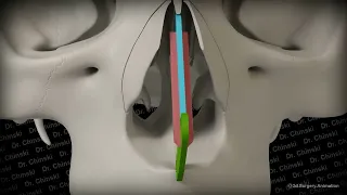 Animación 3D Técnica quirúrgica Rinoplastía Dr. Chinski