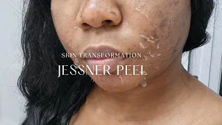 I GOT A NEW FACE! JESSNER PEEL APPLICATION | PEELING PROCESS | PRODUCTS I USED & RESULTS