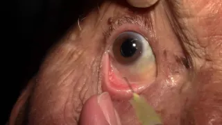 Right Intravitreal Injection of Eylea