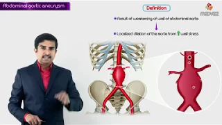 Abdominal aortic aneurysm : Usmle step 1 - Causes , Signs & symptoms , diagnosis , treatment