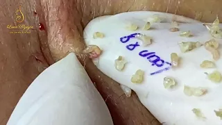 REMOVAL BLACKHEADS FOR MEN (88) Loan Nguyen