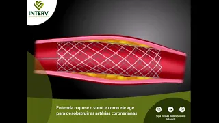 Entenda o que é o stent e como ele age para desobstruir as artérias coronarianas