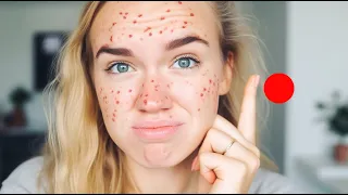 how to prevent acne... | My 5 Best Ways