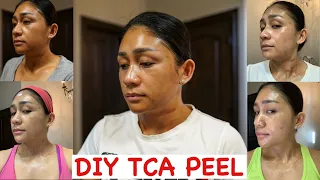 FIRST DIY 25% TCA PEEL