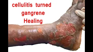 #Cellulitis Infection | Necrotizing Fascitis Healing Stages