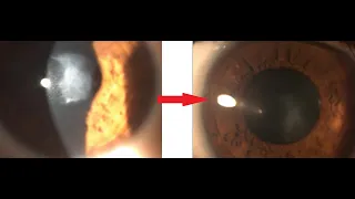 Corneal Scars Correction with LaZrPlastique: Singapore to @GulaniVision