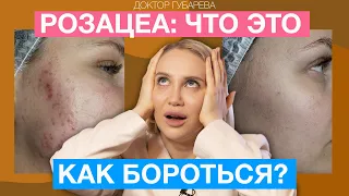 ПОЧЕМУ ПОЯВЛЯЕТСЯ РОЗАЦЕА И КАК С НЕЙ БОРОТЬСЯ?