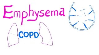 Emphysema - COPD - Pulmonary Medicine