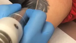 Laser tattoo removal preparing for coverup