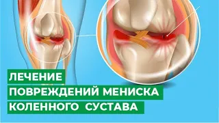 Лечение повреждений мениска коленного сустава