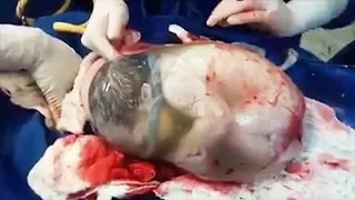 Miracle baby born while still in amniotic sac || Amniotic fluid || Pregnancy