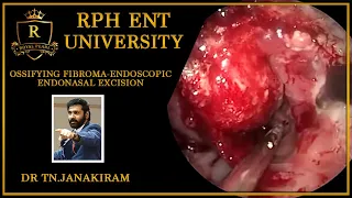 Ossifying fibroma-Endoscopic endonasal excision