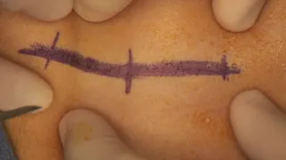 Core Videos (2019): Open Surgical Approaches: Pfannenstiel Incision