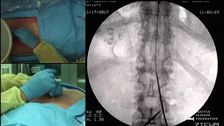 Live Demonstration – Lumbar Spinal Cord Stimulation Trial Brett Stacey, M.D.