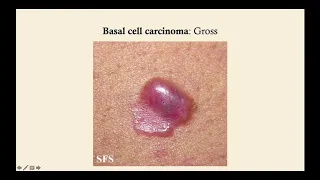 Basal Cell Carcinoma - CRASH! Medical Review Series