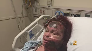 Woman Recants Story About Staten Island Acid Attack