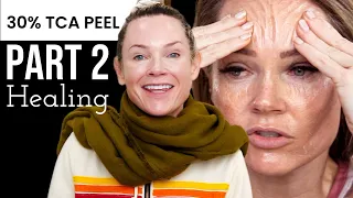 Part 2: TCA RECOVERY post care after chemical peel Before and After